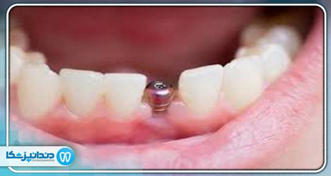 عوارض انجام ایمپلنت دندان
