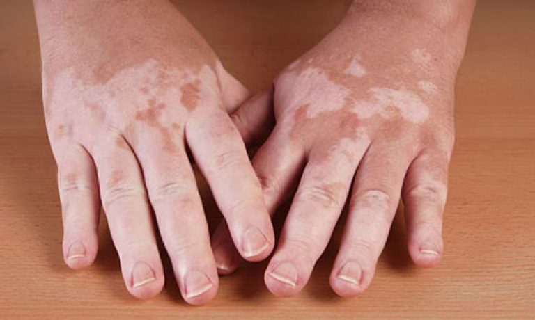 The best dermatologist for vitiligo treatment
