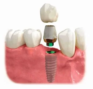 The most dangerous complications of implants
