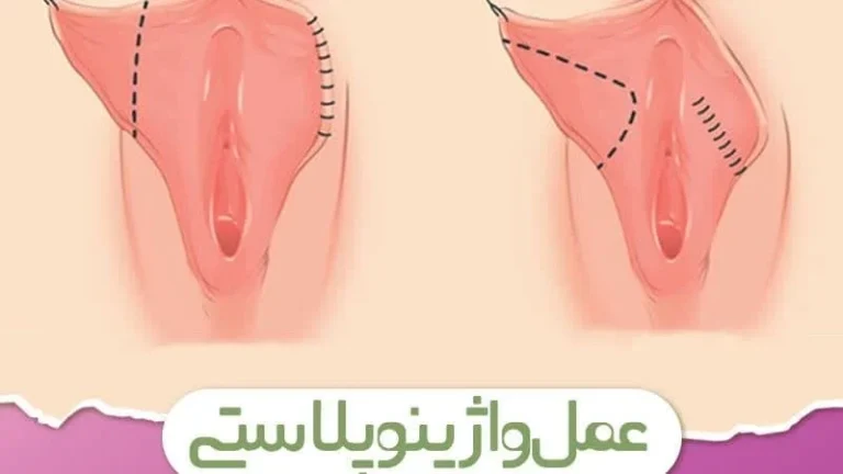 عمومی ویژگیهای جراحی واژینوپلاستی چیست؟