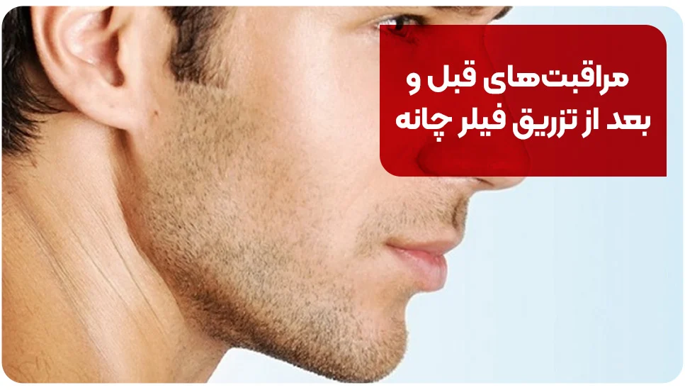 مراقبتهای قبل و بعد از تزریق فیلر چانه